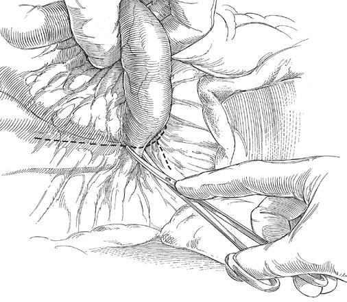 abdominal surgery